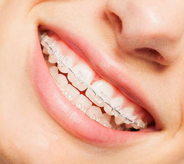 Chamblee Invisible Orthodontics