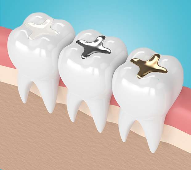 Chamblee Tooth Colored Fillings