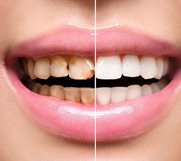 Chamblee Dental Implant Restoration